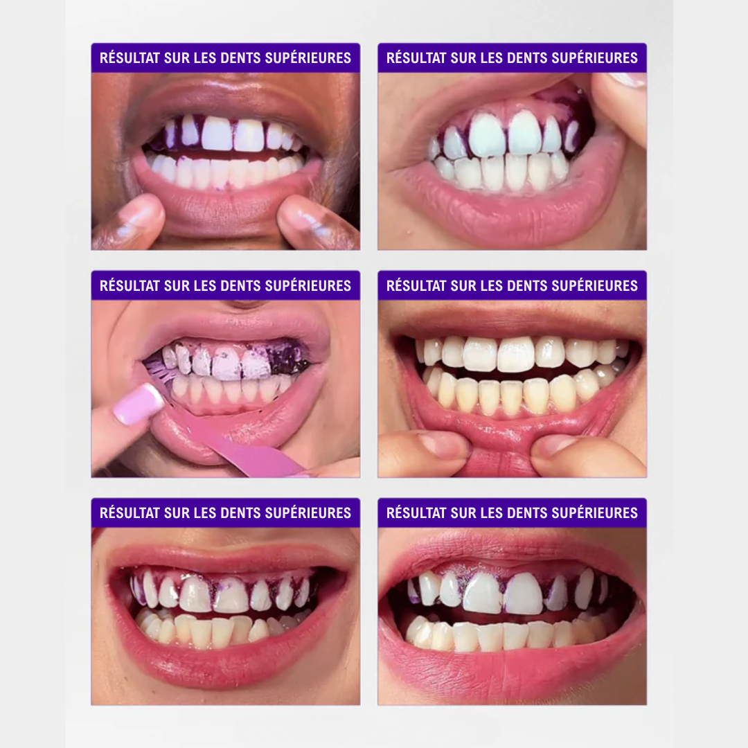 SmileKit – Dents Plus Blanches