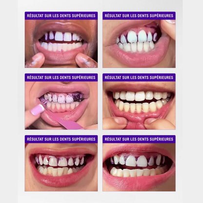 SmileKit – Dents Plus Blanches